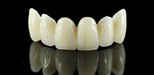 Dental bridge