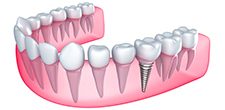 Dental implants