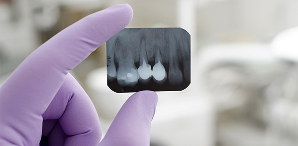 Endodontist examining root canal on xray
